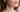 Acne: Understanding Causes, Symptoms, and Effective Adult Treatments - AINMHÍ