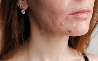 Acne: Understanding Causes, Symptoms, and Effective Adult Treatments - AINMHÍ