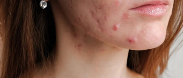 Acne: Understanding Causes, Symptoms, and Effective Adult Treatments - AINMHÍ