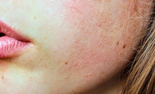 What Causes a Damaged Skin Barrier and How to Fix it - AINMHÍ