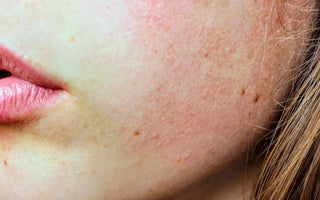 What Causes a Damaged Skin Barrier and How to Fix it - AINMHÍ