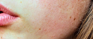 What Causes a Damaged Skin Barrier and How to Fix it - AINMHÍ